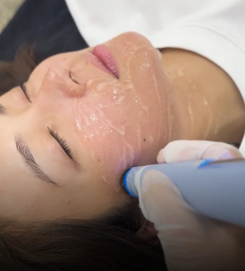 A close-up of an Aivee Exion radiofrequency handpiece gliding over a client’s cheek