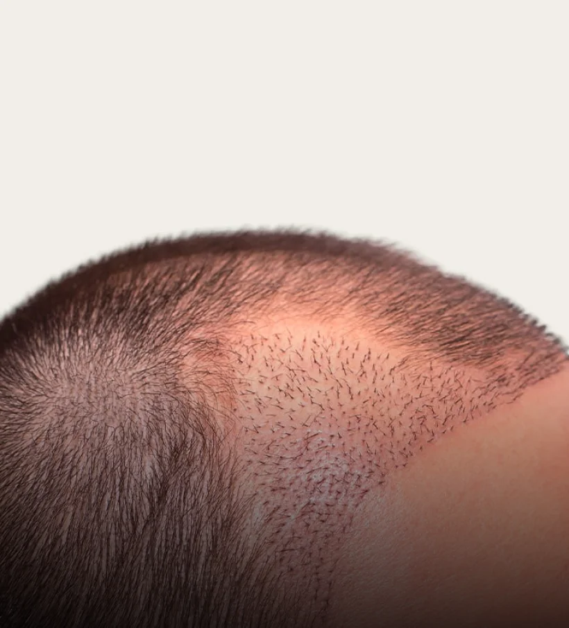 A close-up of a scalp showing newly transplanted hair after an Aivee Hair Transplant