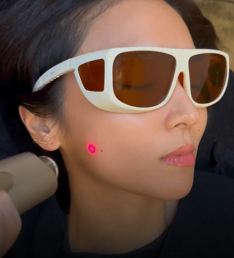 A client wearing white sunglasses with a treatment marker on her cheek during an Aivee Renew 4D session