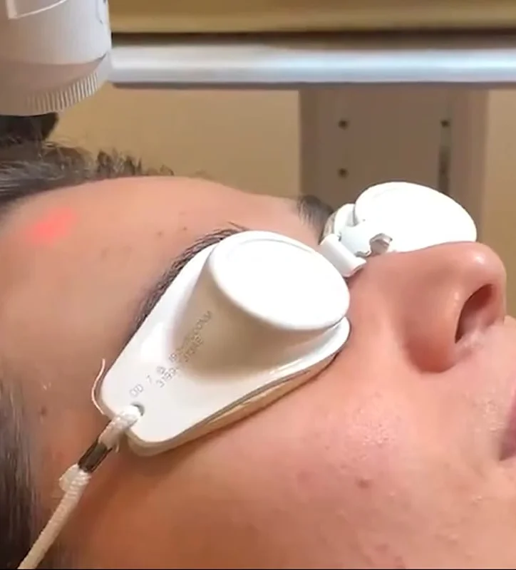 Aivee Aerolase treatment