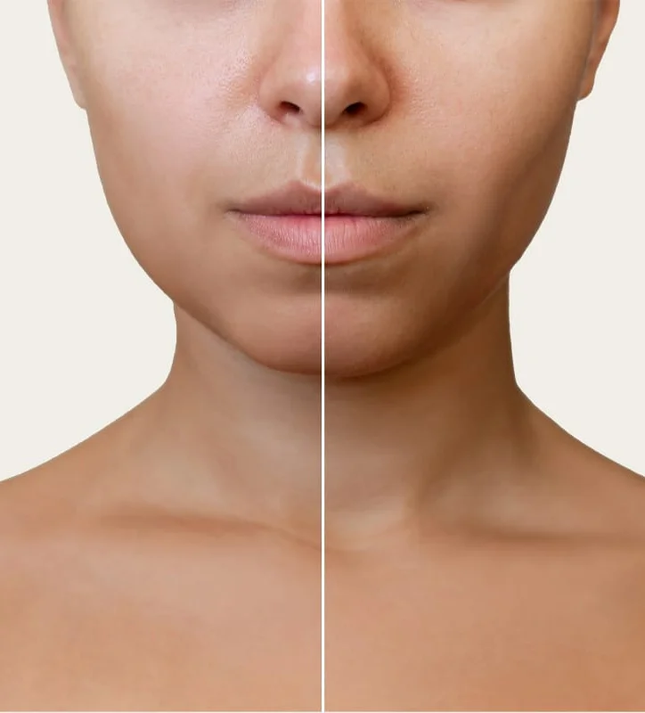 Aivee Buccal Fat Removal treatment