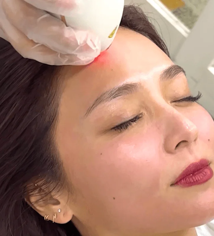 Aivee Gentle Laser Pore treatment