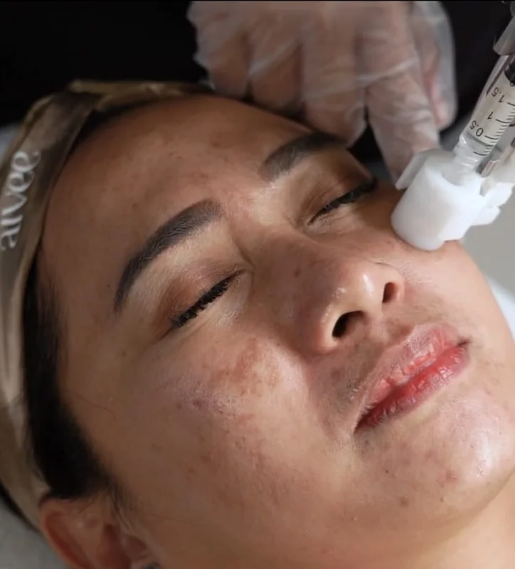 Aivee Meso-Somes treatment