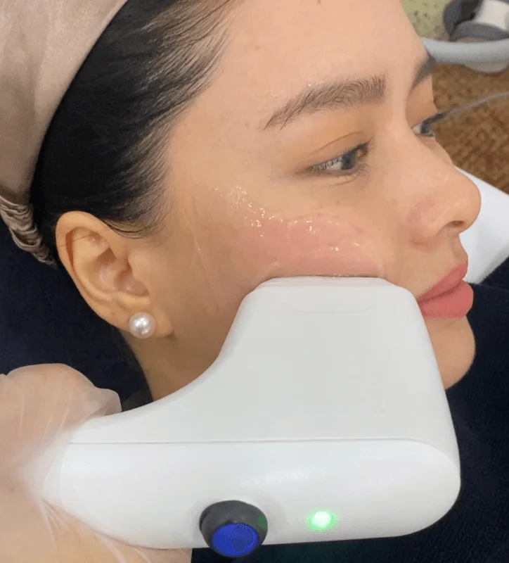Aivee Sofwave treatment