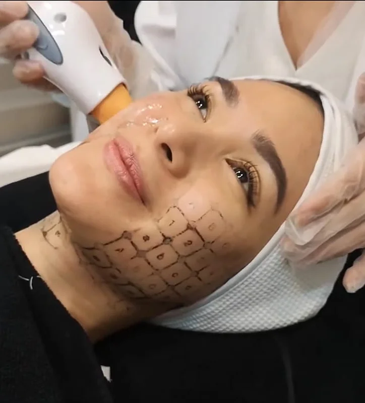 Aivee Thermage FLX treatment