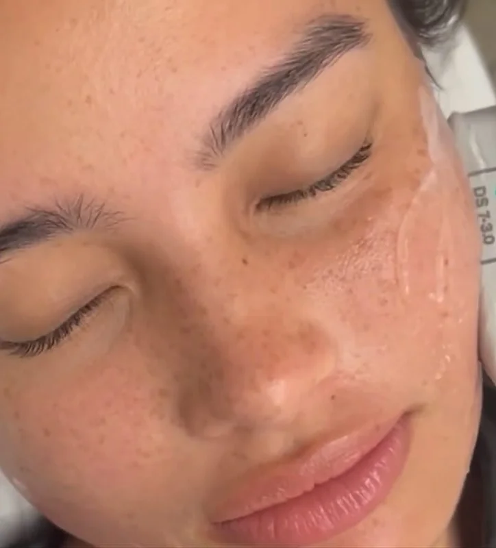 Aivee Ulthera Maxx Lift treatment