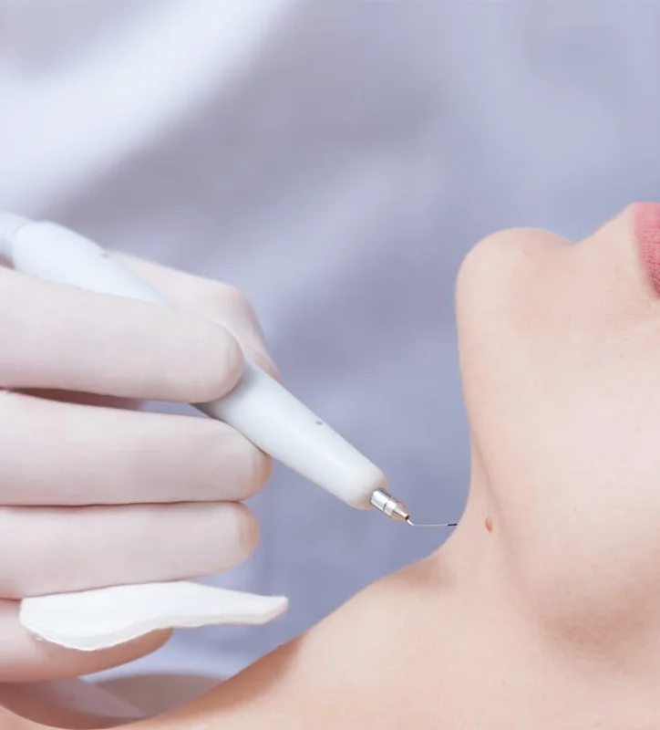ECT or Warts Removal treatment