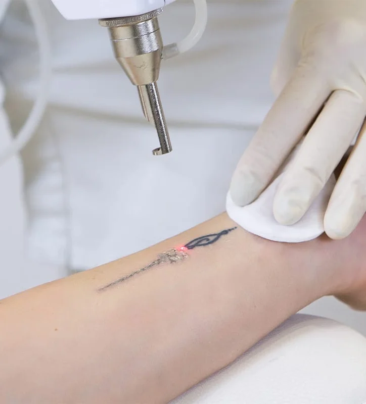 Tattoo Removal treatment
