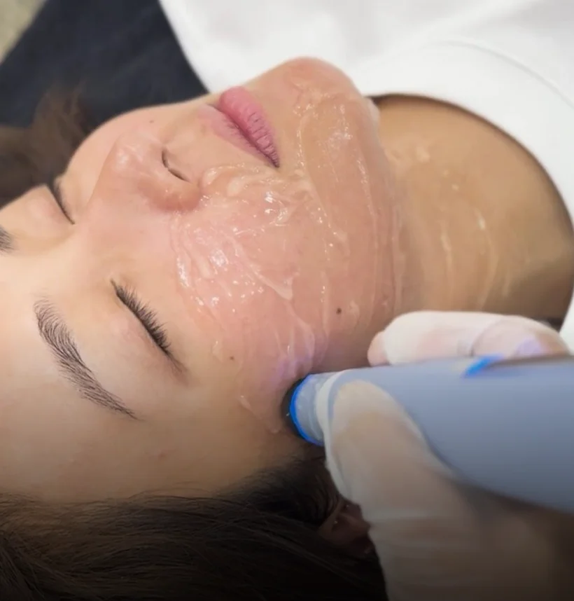 A close-up of an Aivee Exion radiofrequency handpiece gliding over a client’s cheek