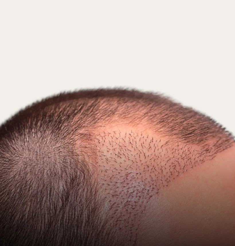 A close-up of a scalp showing newly transplanted hair after an Aivee Hair Transplant