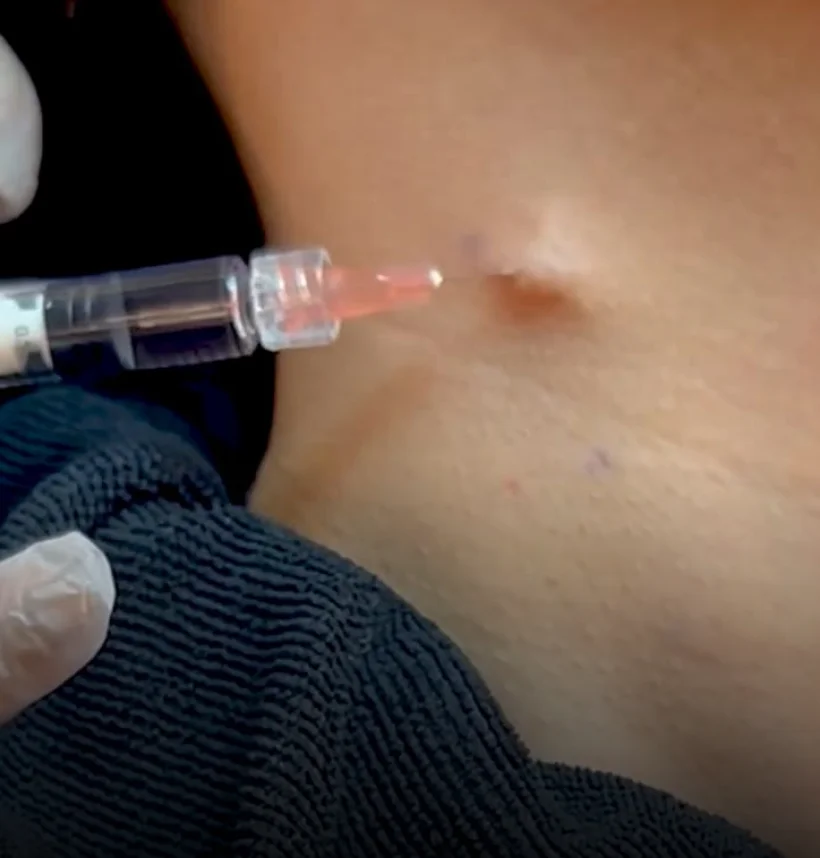 A close-up of a syringe delivering an Aivee Pearl (Profhilo) treatment into the skin
