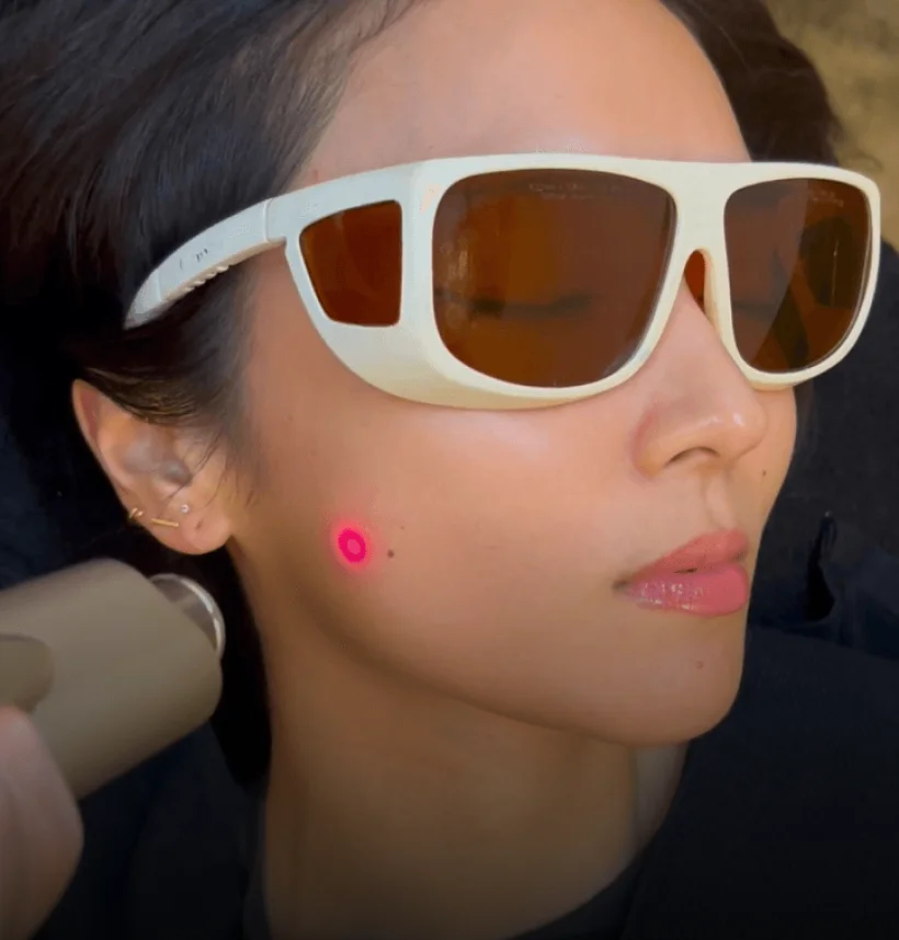 A client wearing white sunglasses with a treatment marker on her cheek during an Aivee Renew 4D session