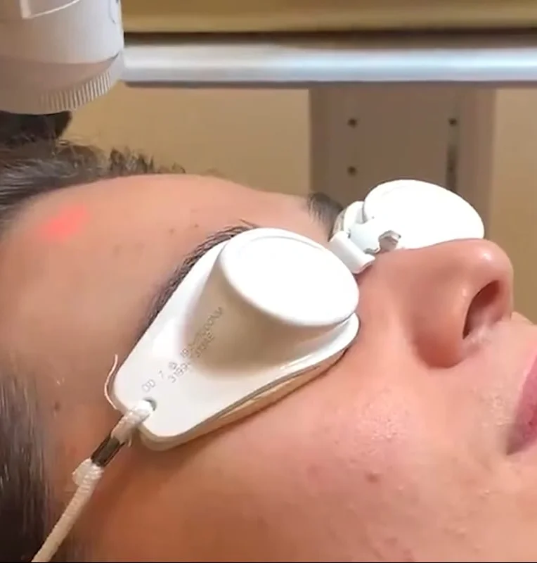 Aivee Aerolase treatment