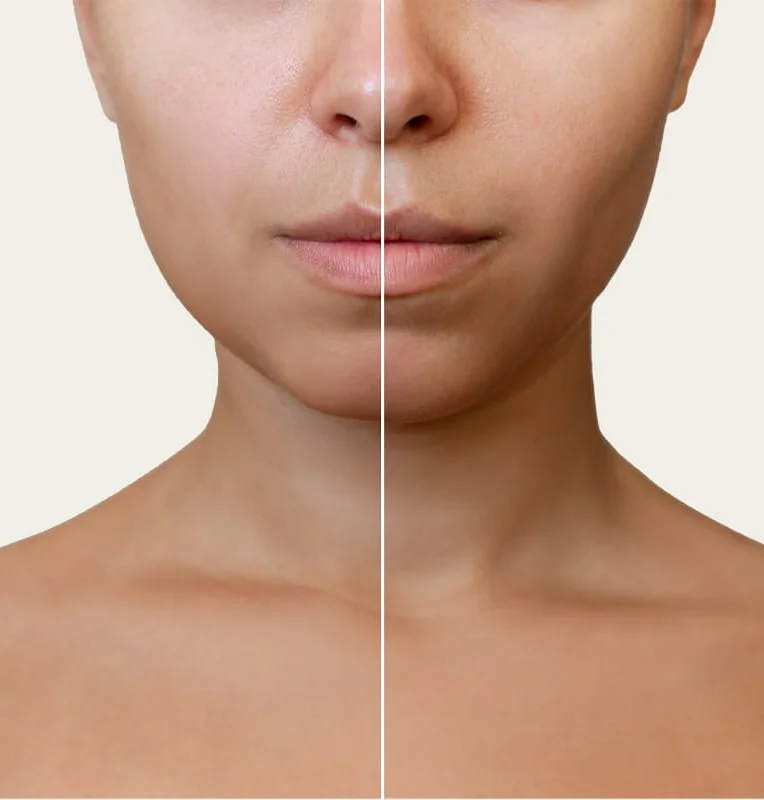 Aivee Buccal Fat Removal treatment