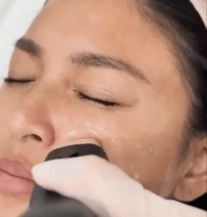 Aivee Density treatment