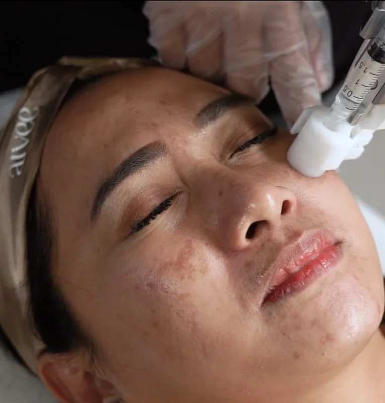 Aivee Meso-Somes treatment