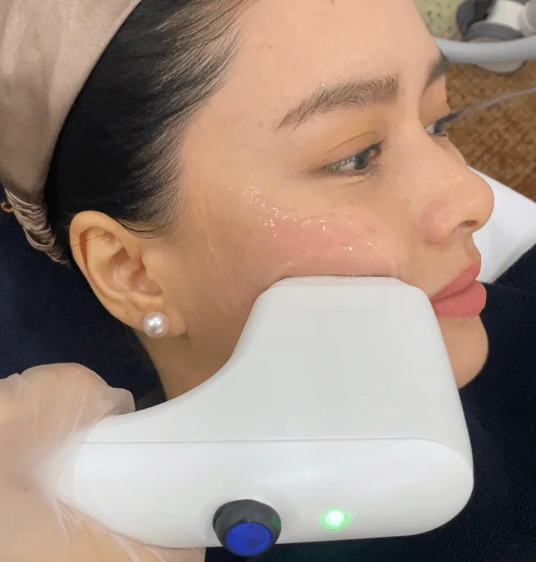 Aivee Sofwave treatment