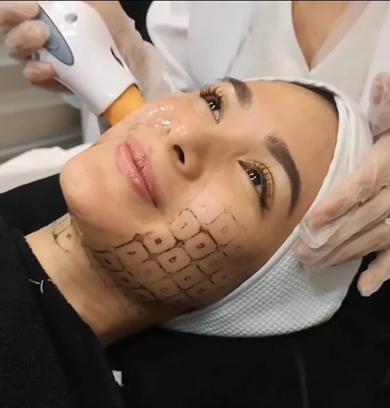 Aivee Thermage FLX treatment