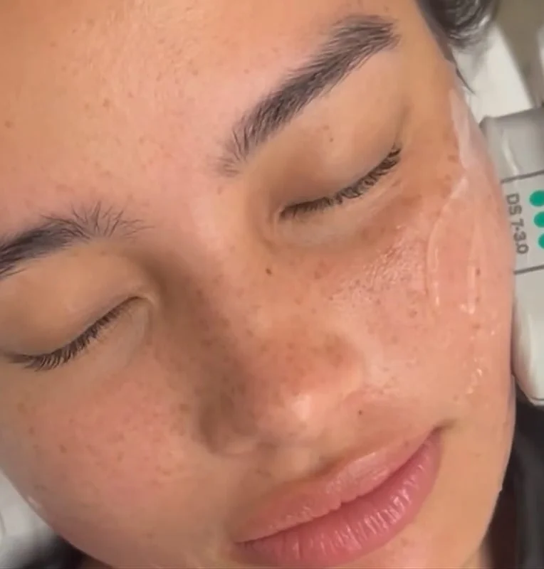 Aivee Ulthera Maxx Lift treatment