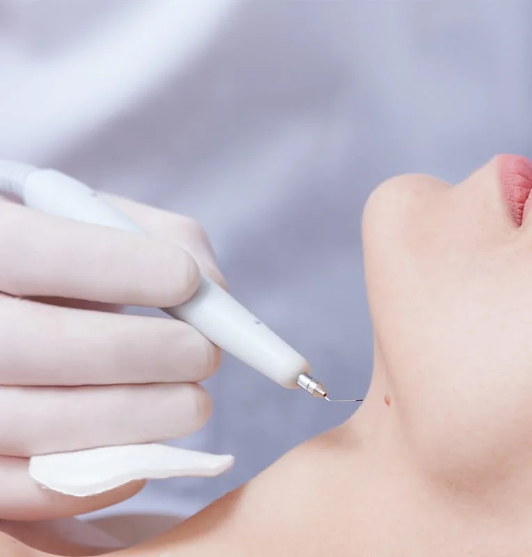 ECT or Warts Removal treatment