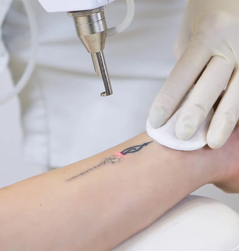 Tattoo Removal treatment